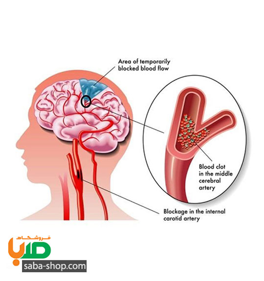 درمان لخته خون روی مغز که باعث فلج شدن شده است