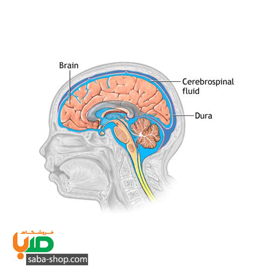 درمان بیماری که مایعات مغزی زیاد دارد