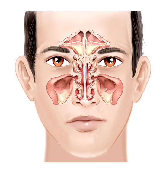 درمان سینوزیت