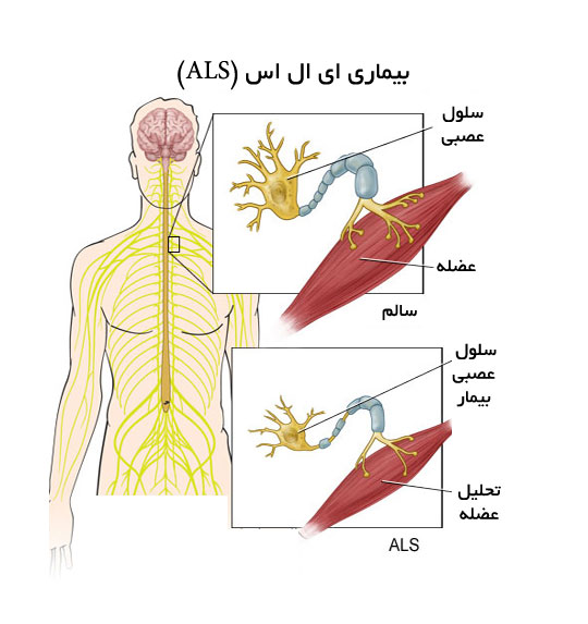 بیماری ای ال اس