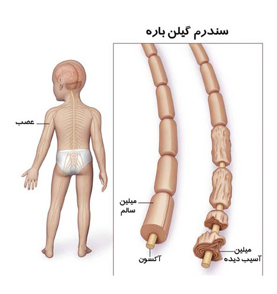 بیماری گلین باره