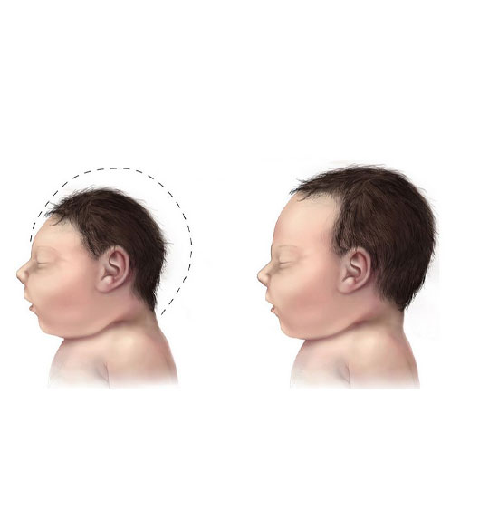 درمان میکرو سفالی (Microcephaly)