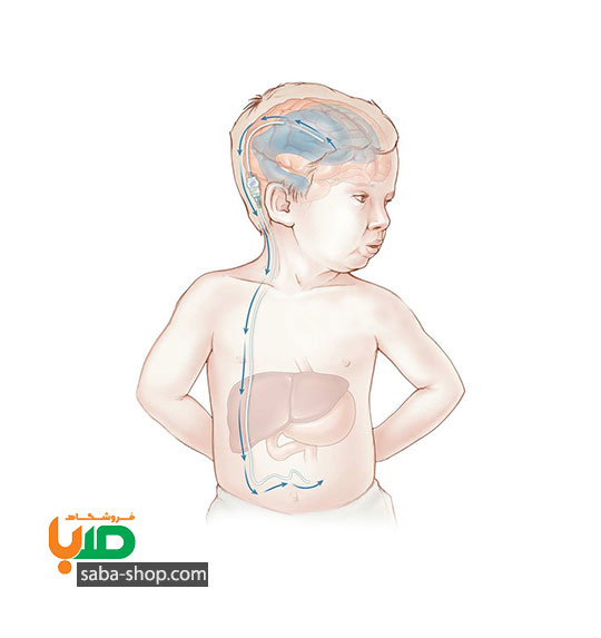 درمان آب آوردن جمجمه بچه (هیدروسفال)