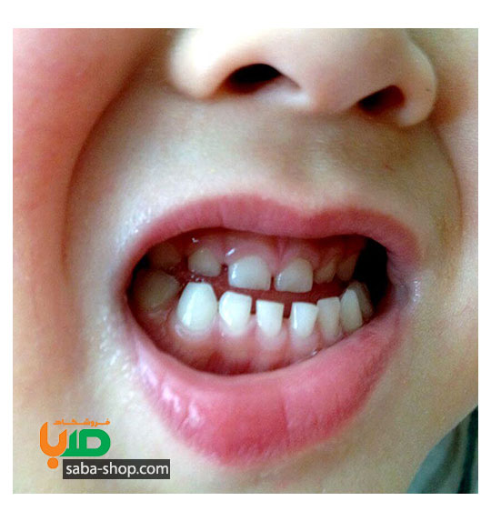 درمان دندان قروچه بچه در شب