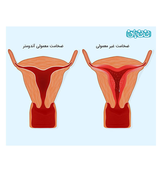 درمان کم بودن ضخامت آندومتر