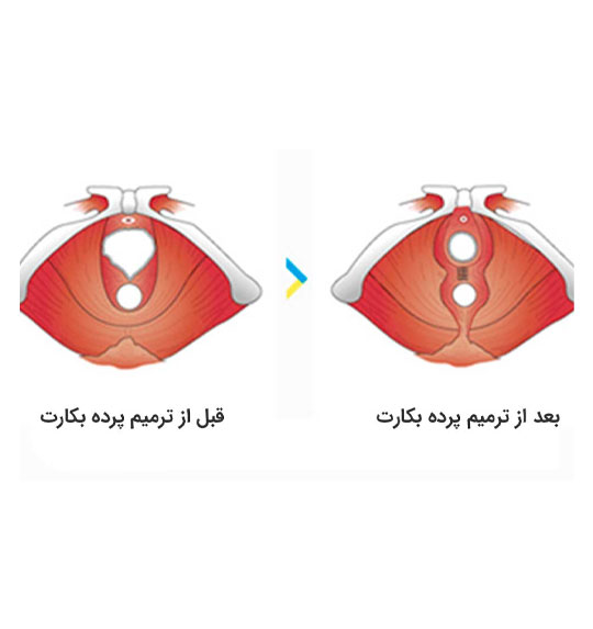 درمان ضخامت پرده بکارت