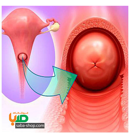 درمان زخم دهانه رحم