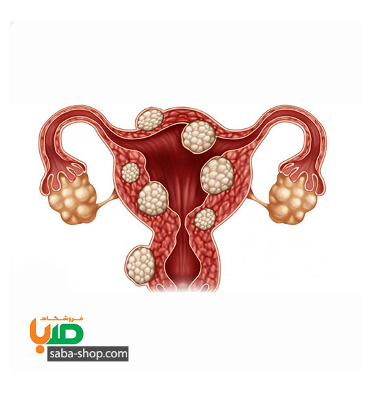 درمان فیبروم و میوم رحم