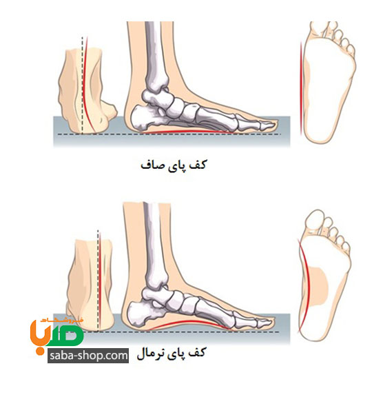 درمان صافی کف پا