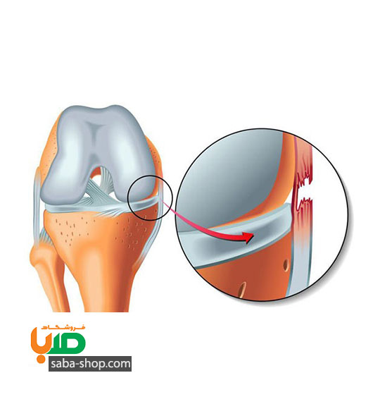 درمان پارگی رباط