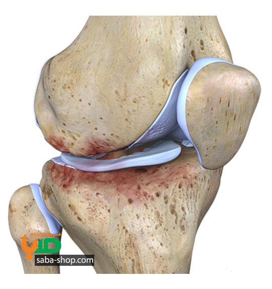 درمان ساییدگی زانو