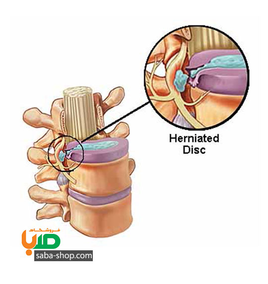 درمان کمردرد و دیسک کمر