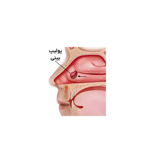 درمان پولیپ بینی