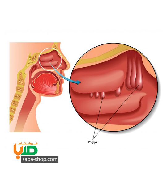 درمان پلیپ بینی