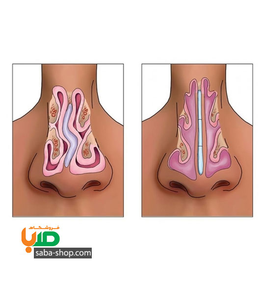 درمان انحراف بینی مادرزادی