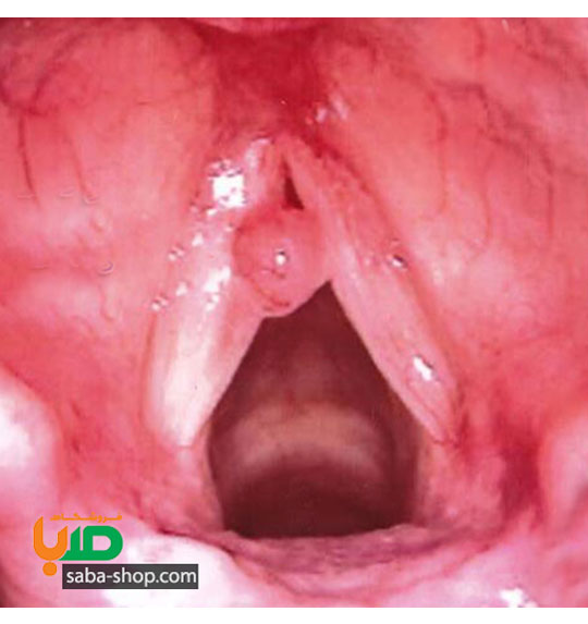 درمان کیست حنجره