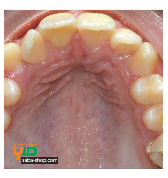 درمان پایین آمدن سقف دهان