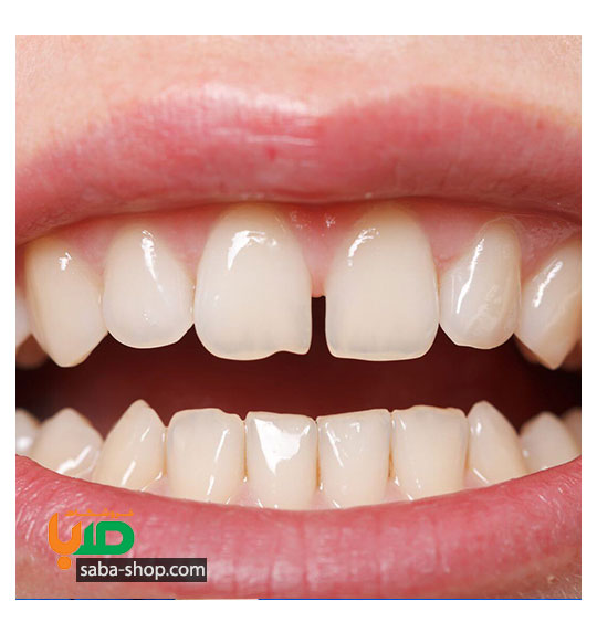 درمان فاصله زیاد بین دندان های بالا