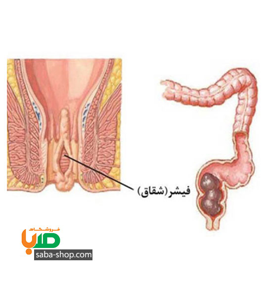 درمان شقاق مقعد (فیشر مقعدی)