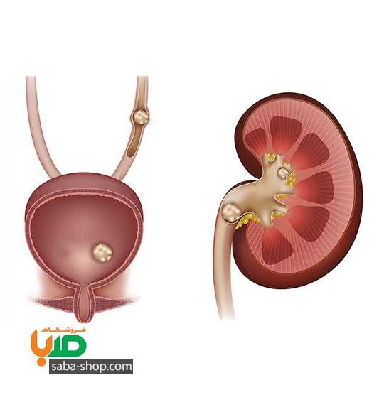 درمان سنگ کلیه
