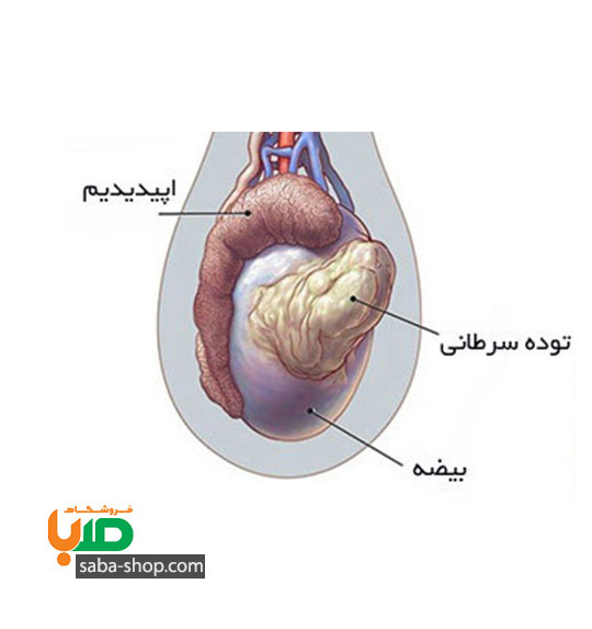 درمان کیست در بیضه ها