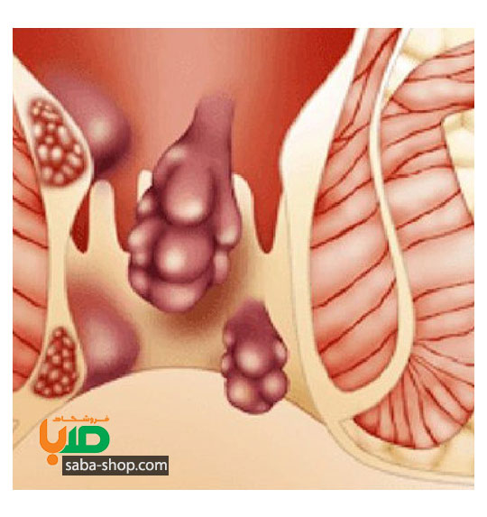 درمان بواسیر ماده