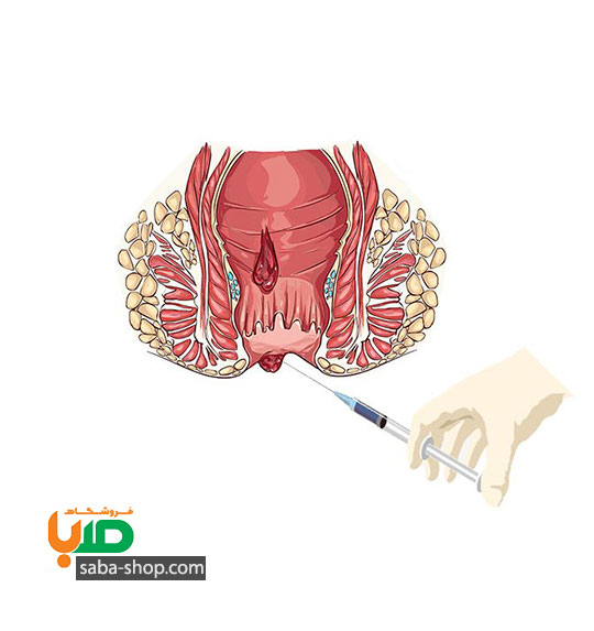 درمان بواسیر