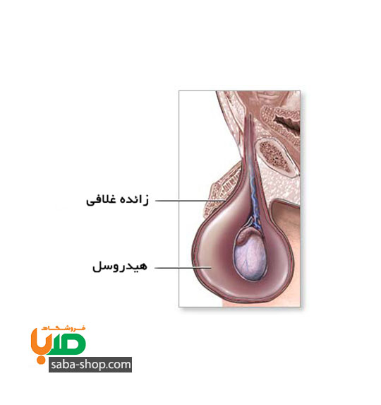 درمان آب آوردن بیضه