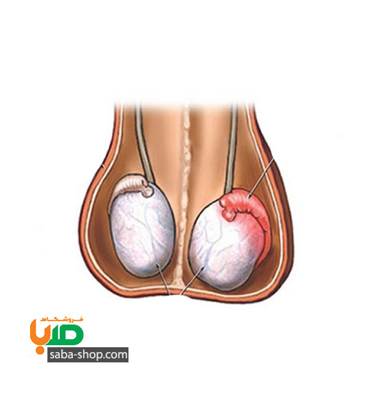 درمان واریکوسل (التهاب بیضه ها)