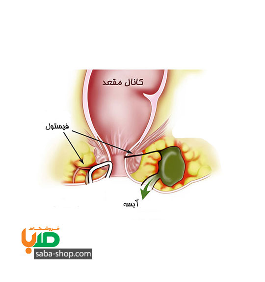 درمان بیماری فیستول