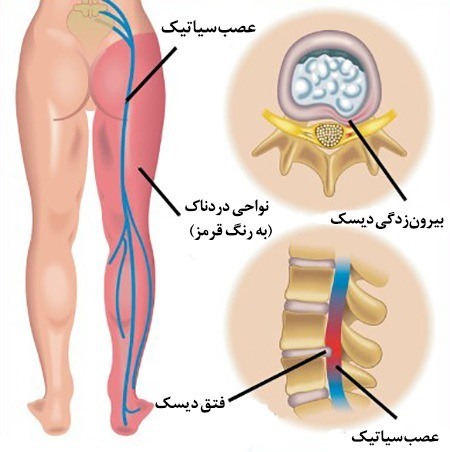 آموزش نکات مربوط به سیاتیک