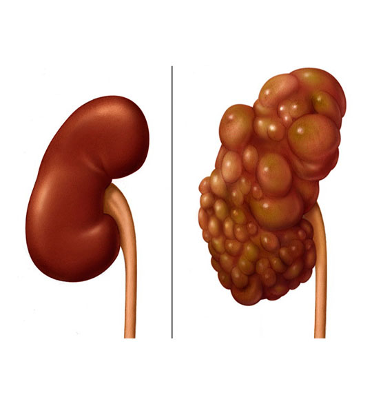 درمان کیست کلیه