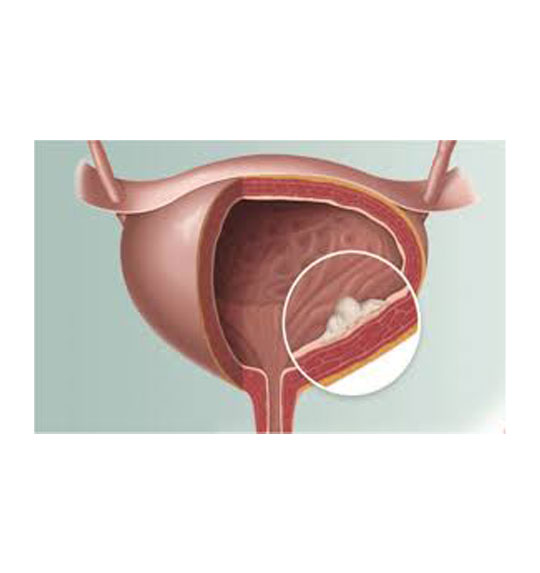 درمان کیست مثانه