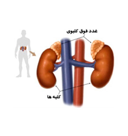 درمان بیماری های غدد فوق کلیوی(آدرنال)
