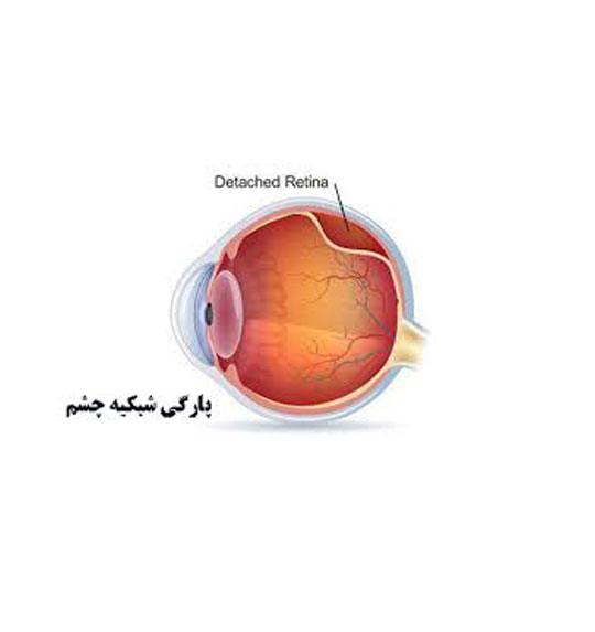 درمان پارگی شبکیه چشم