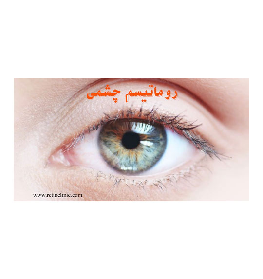 درمان رماتیسم چشمی(سندرم بهجت)